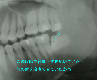 歯のレントゲン