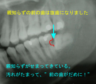 歯のレントゲン