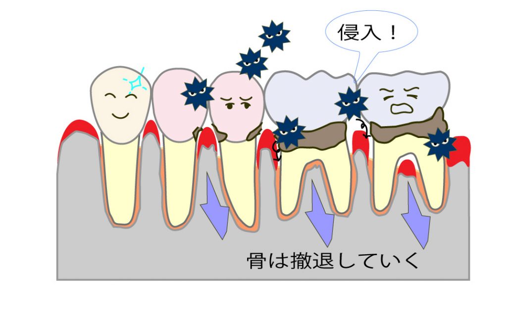 歯周病について