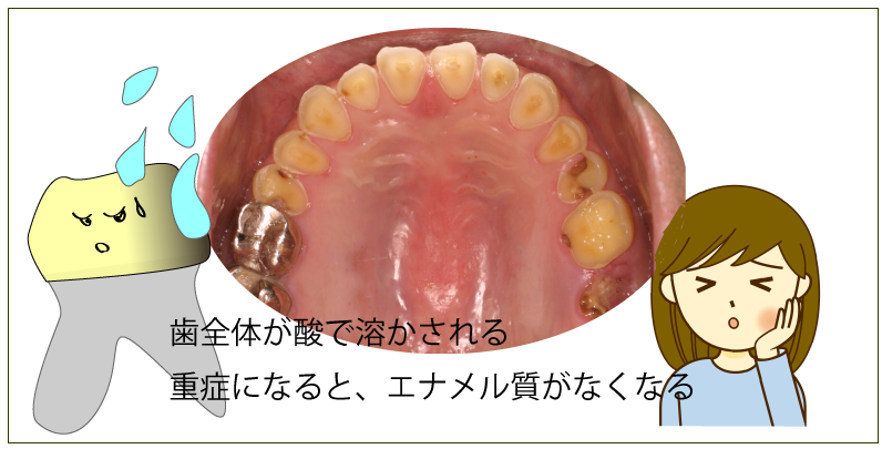 酸蝕症について