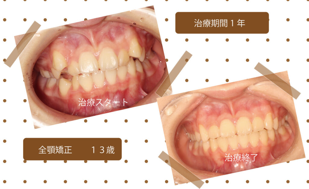 矯正治療の前後