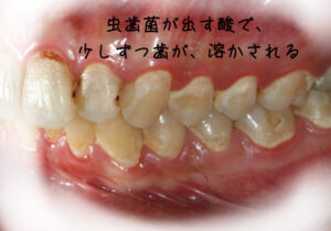 虫歯によって溶けている歯