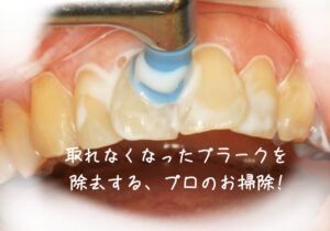 歯面清掃している様子