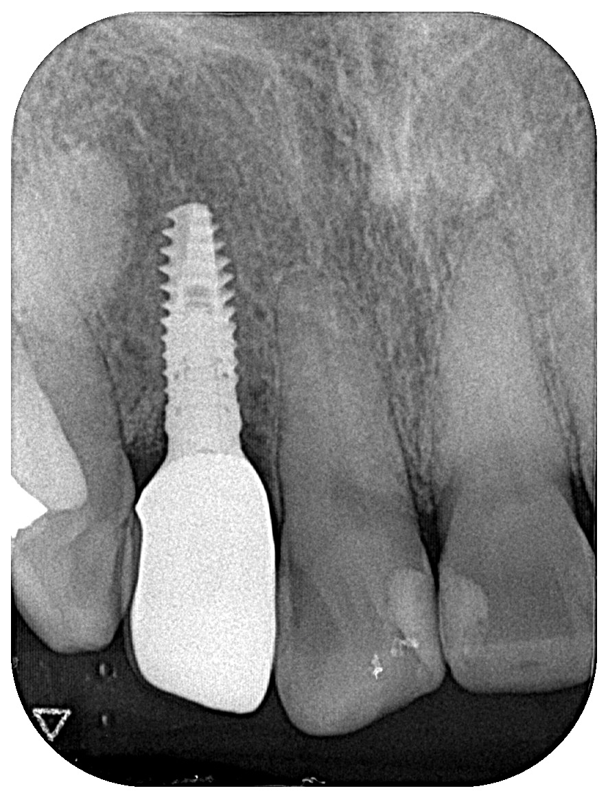 インプラント症例③