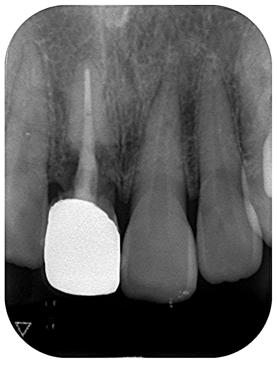 インプラント症例④