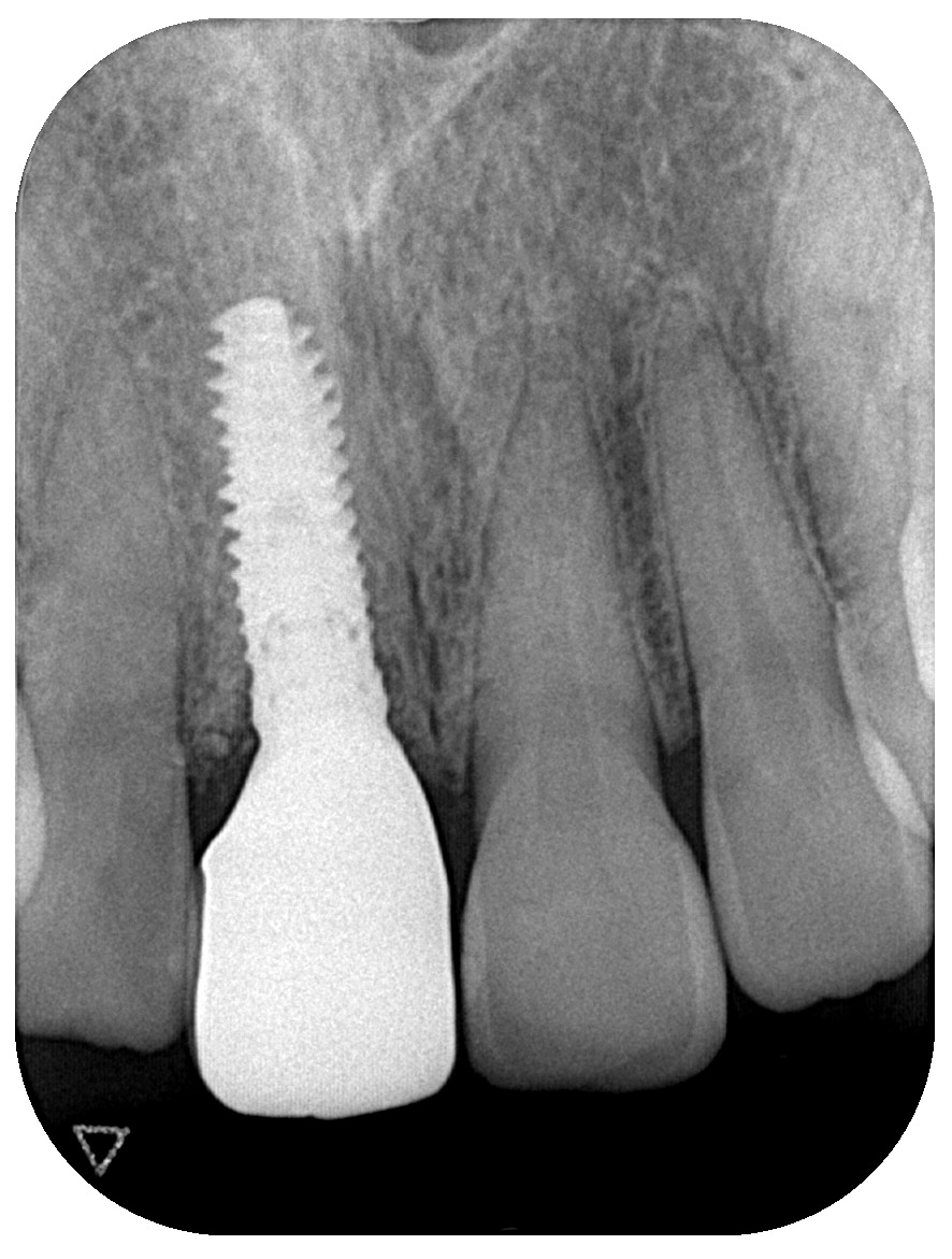 インプラント症例④